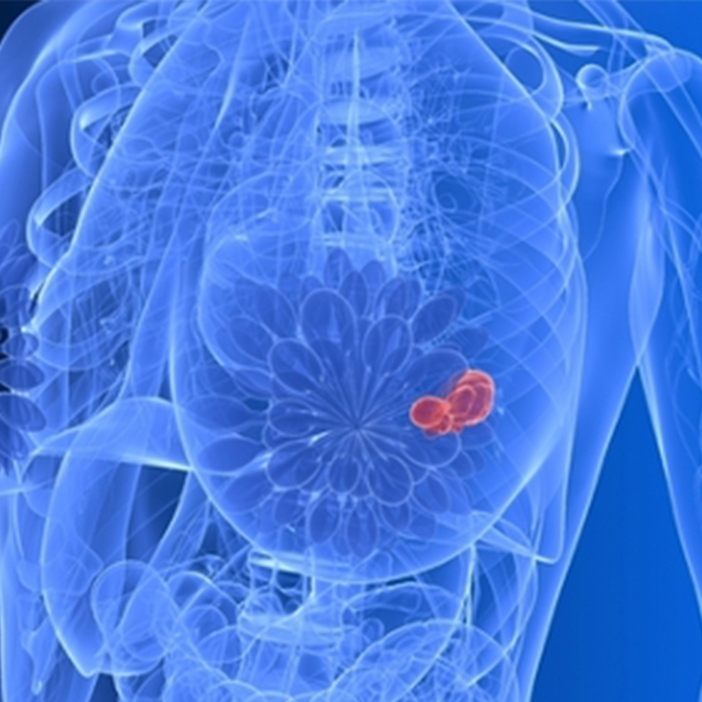 breast cancer screening diagnostic test