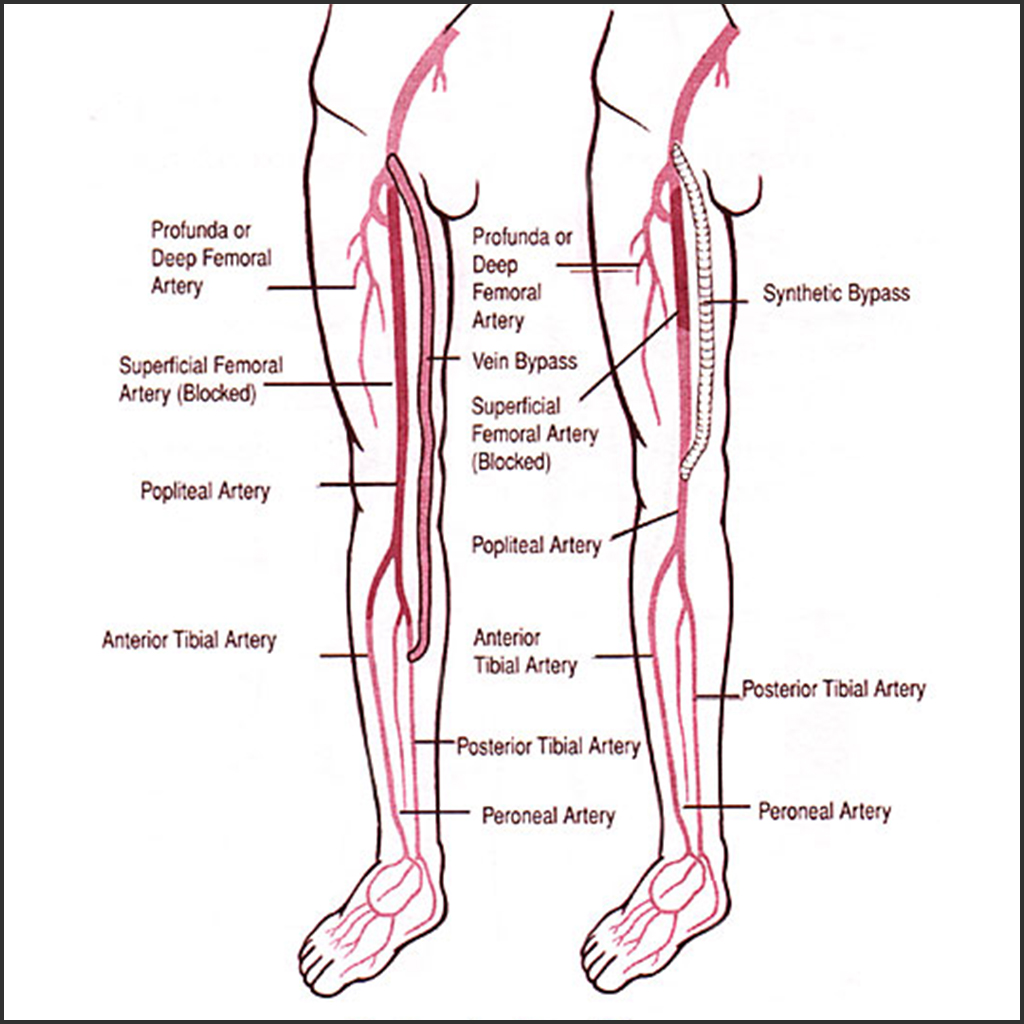 Lower Legs Artery Screening Test